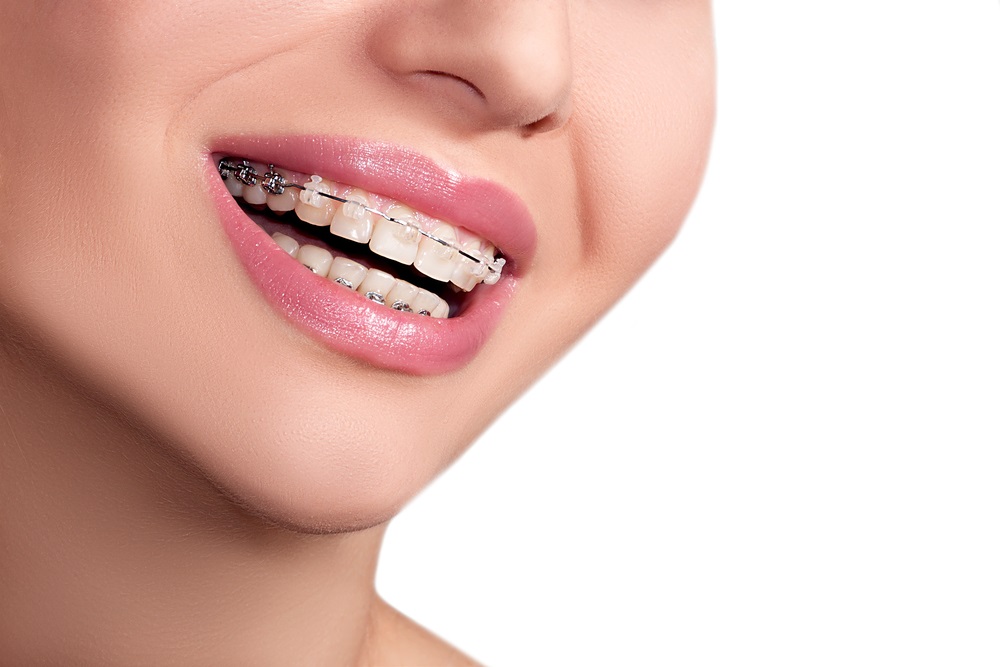 Clear Braces